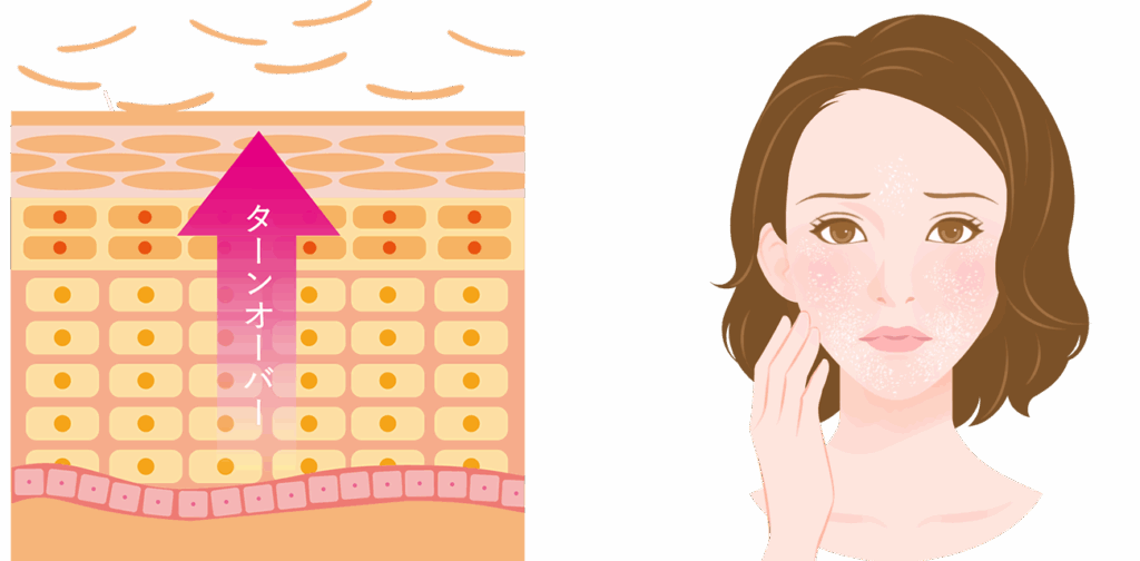 ターンオーバーの乱れ:古い角質が残り肌表面がざらつく
