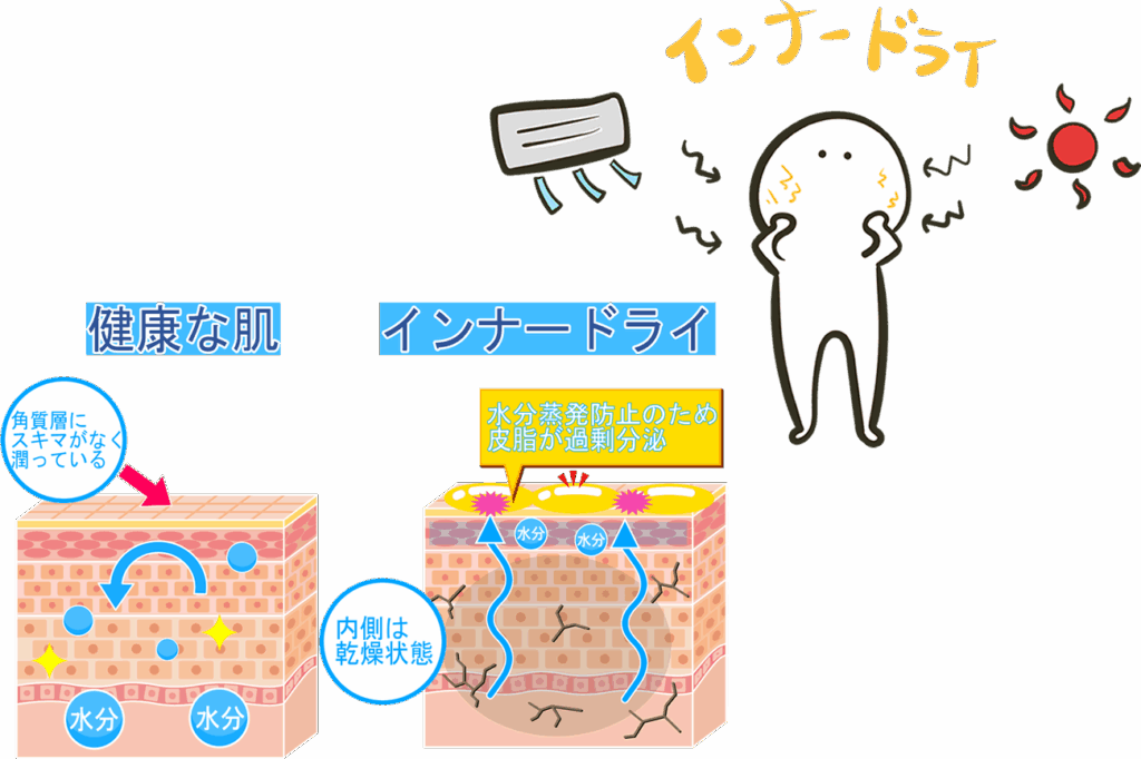 インナードライによる乾燥とゆらぎ肌