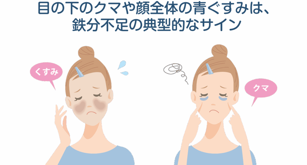 目の下のクマや顔全体の青ぐすみは、鉄分不足の典型的なサインです