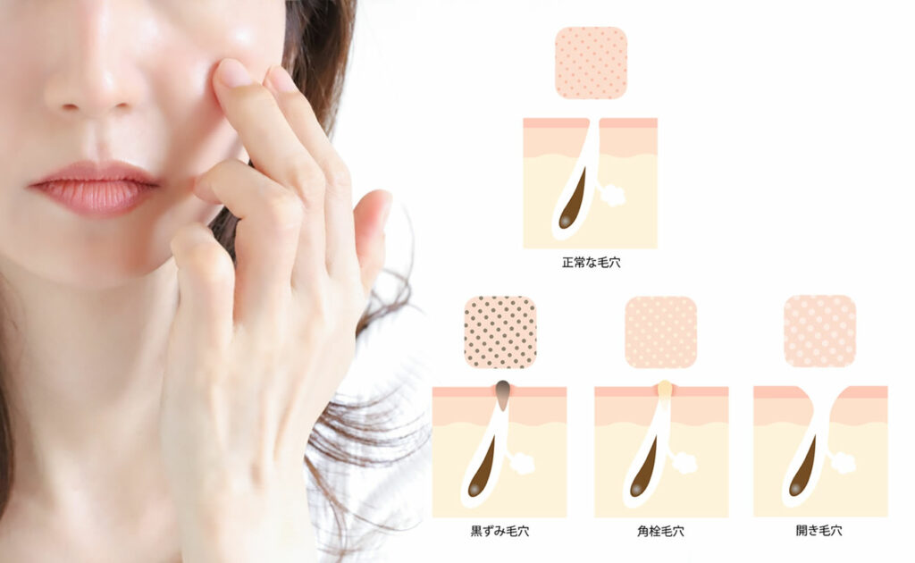 毛穴の黒ずみは3種類に分類される